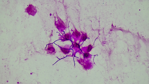 Nocardia