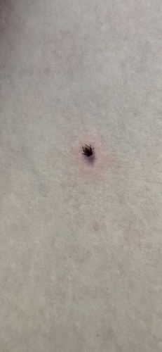 Borrelia miyamotoi