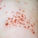 Chicken Pox - Photo (c) James K. Douch, some rights reserved (CC BY-SA), uploaded by James K. Douch