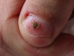 Amblyomma cajennense