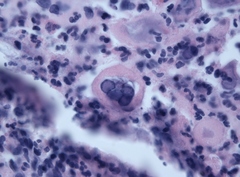 Human alphaherpesvirus one