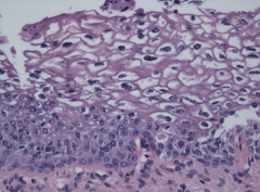 Alphapapillomavirus ten