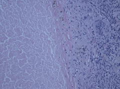 Mycobacterium gordonae