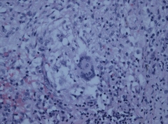Mycobacterium gordonae
