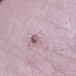 Common Chigger