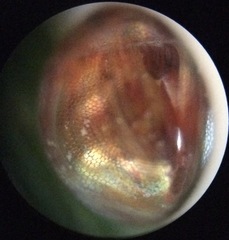 Acanthocephala femorata