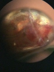 Acanthocephala femorata