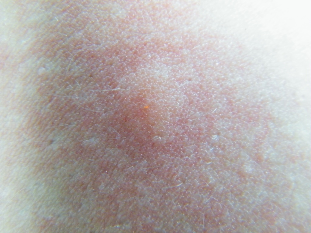 Image showcasing Chiggers from Mejía, Ecuador on June 29, 2009 at 05:41 PM by Fabio ...